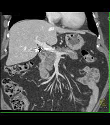 Cirrhosis of Liver With Texture Changes. Focal Fatty Infiltration of the Pancreas - CTisus CT Scan