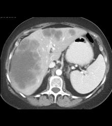 Metastatic Colon Cancer - CTisus CT Scan