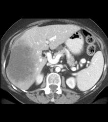 Metastatic Colon Cancer - CTisus CT Scan