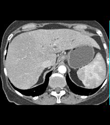 Metastatic Colon Cancer - CTisus CT Scan