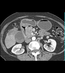 Duodenal Carcinoma With Liver Metastases - CTisus CT Scan