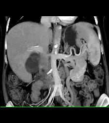 Pancreatic Cancer Encases the Hepatic Artery and Gastroduodenal Artery (GDA) - CTisus CT Scan