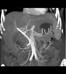 Pancreatic Cancer Encases the Hepatic Artery and Gastroduodenal Artery (GDA) - CTisus CT Scan