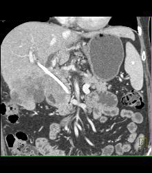 Pancreatic Cancer Encases the Hepatic Artery and Gastroduodenal Artery (GDA) - CTisus CT Scan