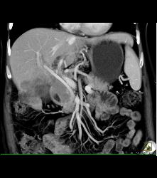 Pancreatic Cancer Encases the Hepatic Artery and Gastroduodenal Artery (GDA) - CTisus CT Scan