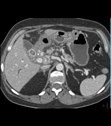 Gb Cancer Encases the Hepatic Artery. Nodes in Porta - CTisus CT Scan