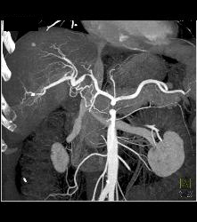 Gb Cancer Encases the Hepatic Artery. Nodes in Porta - CTisus CT Scan