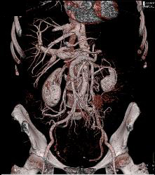 Splenic Vein Occluded By Tumor Woth Collaterals Through Gonadal Veins - CTisus CT Scan