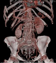 Splenic Vein Occluded By Tumor Woth Collaterals Through Gonadal Veins - CTisus CT Scan