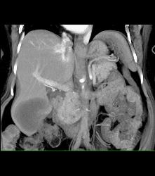 Liver Metastases From Pancreatic Cancer - CTisus CT Scan