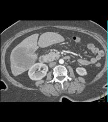 Liver Metastases From Pancreatic Cancer - CTisus CT Scan