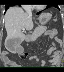 Liver Metastases From Pancreatic Cancer - CTisus CT Scan