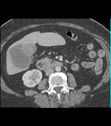 Liver Metastases From Pancreatic Cancer - CTisus CT Scan