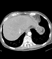 Hepatocellular Carcinoma (Hepatoma) - See Full Sequence of Images - CTisus CT Scan