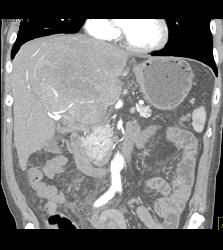 Hepatocellular Carcinoma (Hepatoma) - See Full Sequence of Images - CTisus CT Scan