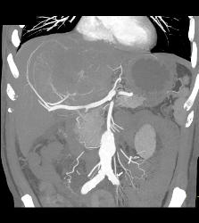 Hepatocellular Carcinoma (Hepatoma) - See Full Sequence of Images - CTisus CT Scan