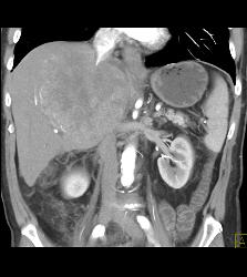 Hepatocellular Carcinoma (Hepatoma) - See Full Sequence of Images - CTisus CT Scan