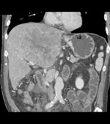 Hepatocellular Carcinoma (Hepatoma) - See Full Sequence of Images - CTisus CT Scan