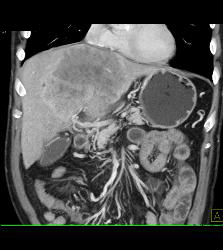 Hepatocellular Carcinoma (Hepatoma) - See Full Sequence of Images - CTisus CT Scan