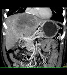 Hepatocellular Carcinoma (Hepatoma) - See Full Sequence of Images - CTisus CT Scan