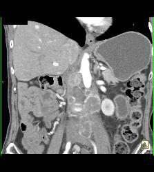 Right Nephrectomy for Renal Cell Carcinoma (RCC) With Recurrent Nodes and Vascular Liver Metastases - CTisus CT Scan