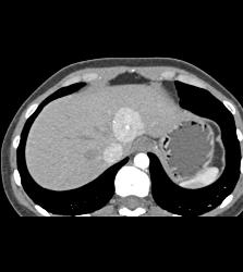 Focal Nodular Hyperplasia (FNH) - CTisus CT Scan