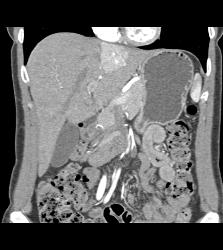 Focal Nodular Hyperplasia (FNH) - CTisus CT Scan