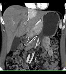 Focal Nodular Hyperplasia (FNH) - CTisus CT Scan