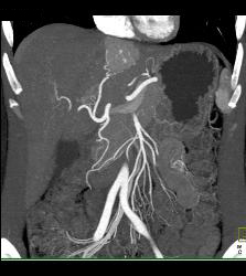 Focal Nodular Hyperplasia (FNH) - CTisus CT Scan