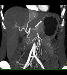 Focal Nodular Hyperplasia (FNH) - CTisus CT Scan