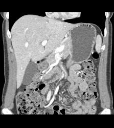 Focal Nodular Hyperplasia (FNH) - CTisus CT Scan