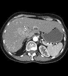 Hepatocellular Carcinoma (Hepatoma) - See All Phases of This Tumor - CTisus CT Scan