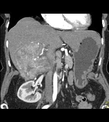 Hepatocellular Carcinoma (Hepatoma) - See All Phases of This Tumor - CTisus CT Scan