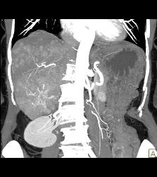 Hepatocellular Carcinoma (Hepatoma) - See All Phases of This Tumor - CTisus CT Scan