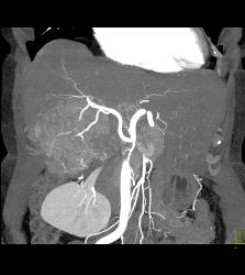 Hepatocellular Carcinoma (Hepatoma) - See All Phases of This Tumor - CTisus CT Scan