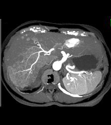 Hepatocellular Carcinoma (Hepatoma) - See All Phases of This Tumor - CTisus CT Scan