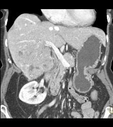 Hepatocellular Carcinoma (Hepatoma) - See All Phases of This Tumor - CTisus CT Scan