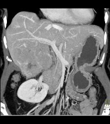 Hepatocellular Carcinoma (Hepatoma) - See All Phases of This Tumor - CTisus CT Scan