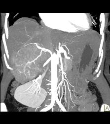 Hepatocellular Carcinoma (Hepatoma) - See All Phases of This Tumor - CTisus CT Scan