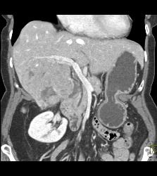 Hepatocellular Carcinoma (Hepatoma) - See All Phases of This Tumor - CTisus CT Scan