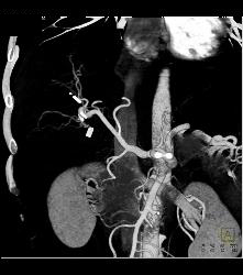 Hepatic Arterial Anatomy - CTisus CT Scan