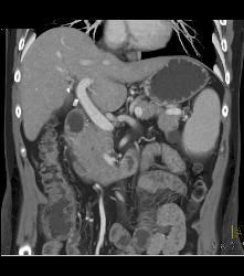 1 Cm Metastases to Liver - CTisus CT Scan