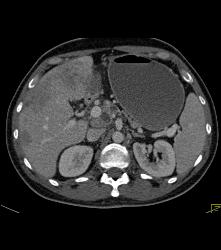 Pancreatic Cancer With Liver Metastases - CTisus CT Scan