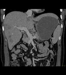 Pancreatic Cancer With Liver Metastases - CTisus CT Scan