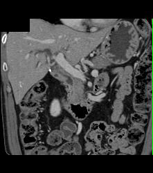 Distal Common Bile Duct (CBD) Tumor - CTisus CT Scan