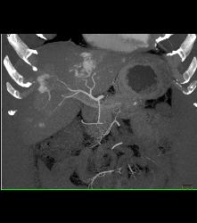 Vascular Liver Metastases - CTisus CT Scan