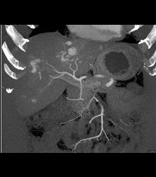 Vascular Liver Metastases - CTisus CT Scan