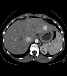 Focal Nodular Hyperplasia (FNH) Vs Hepatocellular Carcinoma (Hepatoma) (HCC). Since Cirrhotic Liver Was HCC - CTisus CT Scan