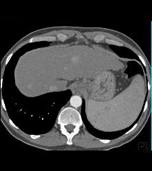 Focal Nodular Hyperplasia (FNH) Vs Hepatocellular Carcinoma (Hepatoma) (HCC). Since Cirrhotic Liver Was HCC - CTisus CT Scan