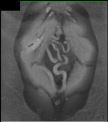 Cirrhosis With Varices - CTisus CT Scan